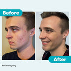 Proactiv 3 Step Acne Treatment - Benzoyl Peroxide Face Wash, Repairing Acne Spot Treatment for Face and Body, Exfoliating Toner - 90 Day Complete Acne Skin Care Kit